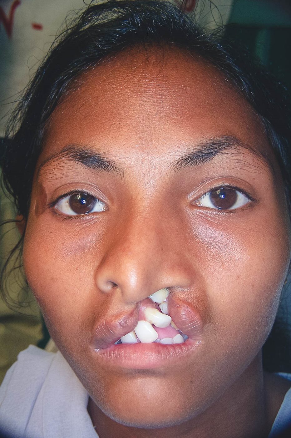 cci-types-of-cleft-lip-jaw-and-palate-prof-sailer-explains