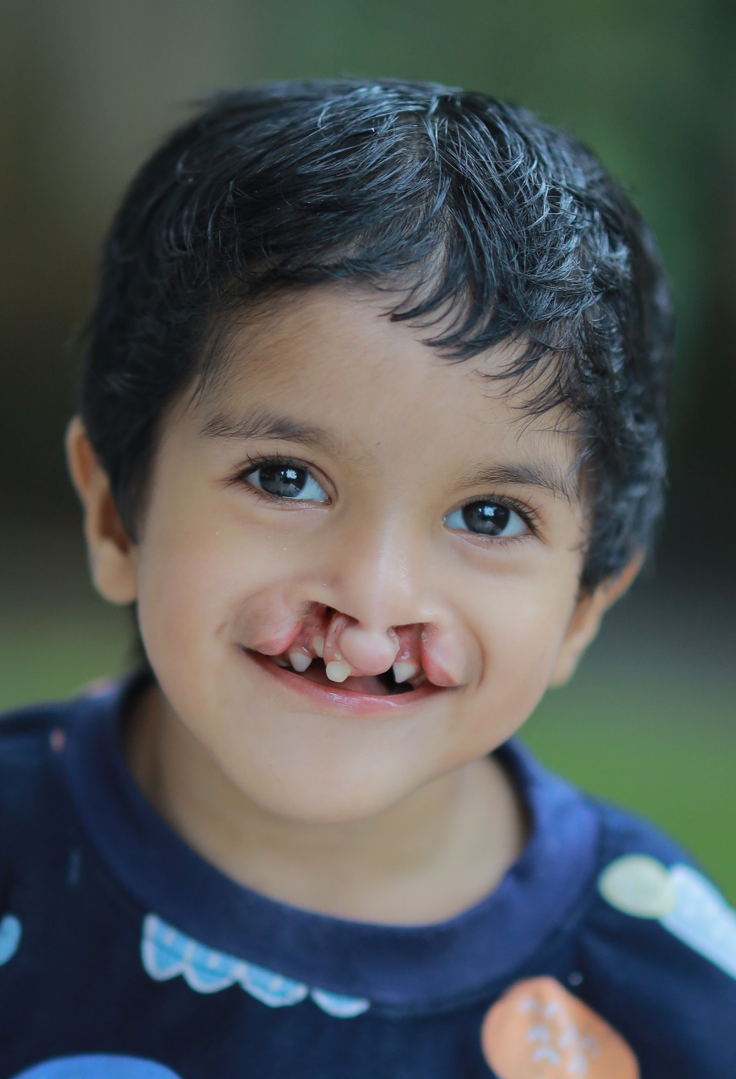 Nathan, ein indischer Junge mit Gaumenspalte, lächelt in die Kamera