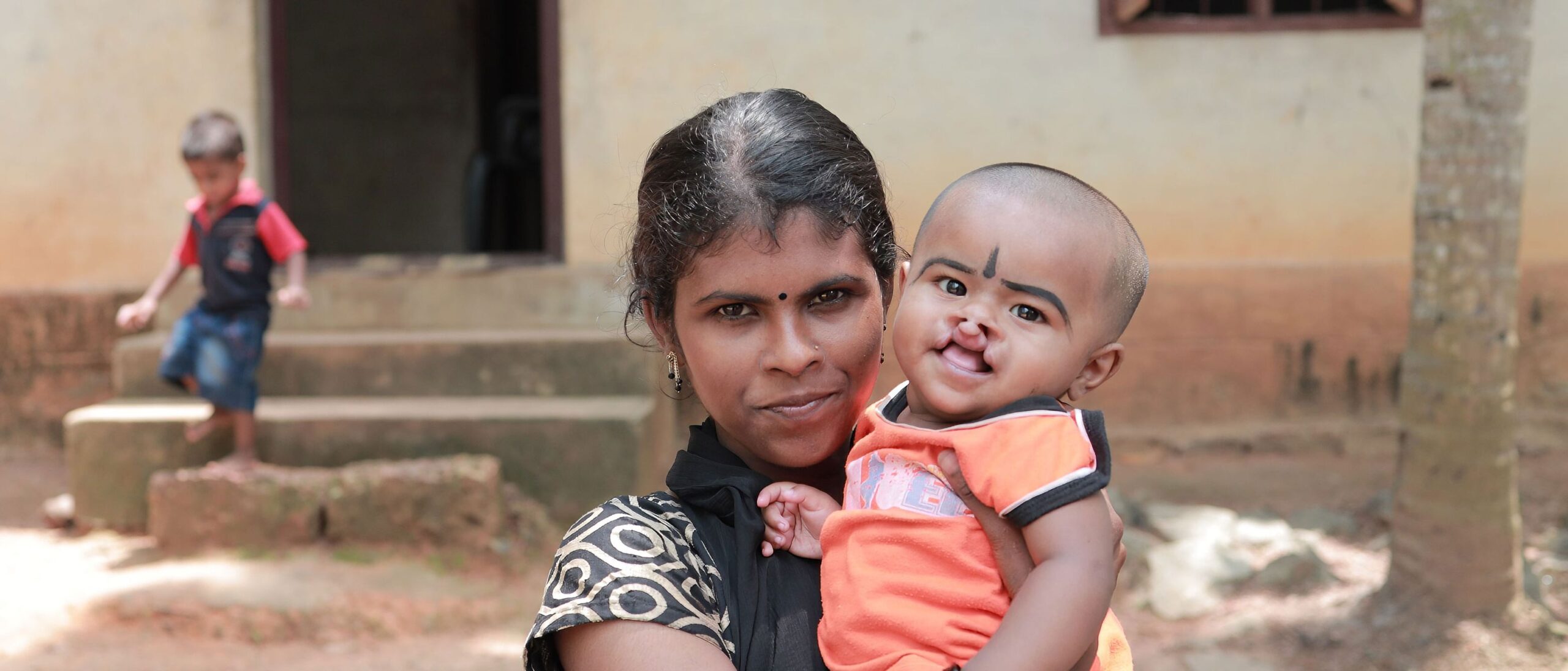 junge Frau mit Baby auf dem Arm, das Baby hat eine Gaumenspalte